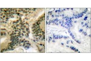 Immunohistochemistry analysis of paraffin-embedded human lung carcinoma, using PKC zeta (Phospho-Thr410) Antibody. (PKC zeta antibody  (pThr410))