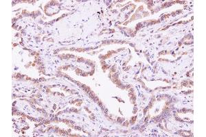 IHC-P Image CIB1 antibody detects CIB1 protein at cytoplasm on human lung carcinoma by immunohistochemical analysis. (CIB1 antibody)