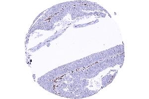 Colorectal adenocarcinoma with a complete loss of MRE11 staining in tumor cells (Recombinant Mre11 antibody)