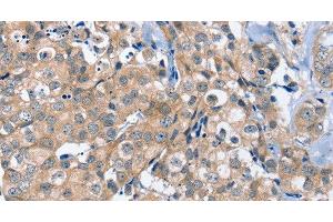 Immunohistochemistry of paraffin-embedded Human breast cancer using OTUB1 Polyclonal Antibody at dilution of 1:40 (OTUB1 antibody)