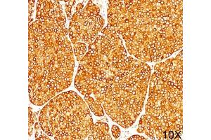 IHC staining of melanoma tissue (10X) with Tyrosinase antibody (T311). (TYR antibody)