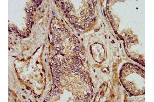 IHC image of ABIN7169503 diluted at 1:500 and staining in paraffin-embedded human prostate cancer performed on a Leica BondTM system.