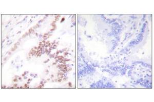Immunohistochemistry analysis of paraffin-embedded human lung carcinoma tissue, using p300 antibody. (p300 antibody  (N-Term))