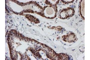 Immunohistochemical staining of paraffin-embedded Human breast tissue using anti-ATRIP mouse monoclonal antibody. (ATRIP antibody  (AA 42-309))