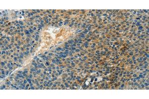 Immunohistochemistry of paraffin-embedded Human liver cancer tissue using DGK beta Polyclonal Antibody at dilution 1:60 (DGKB antibody)