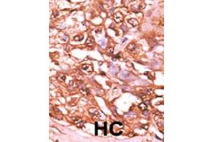Formalin-fixed and paraffin-embedded human hepatocellular carcinoma tissue reacted with STAT5A (phospho S726) polyclonal antibody  which was peroxidase-conjugated to the secondary antibody followed by AEC staining. (STAT5A antibody  (pSer726))