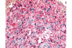 Anti-KCNMB3 antibody IHC of human Brain, Glioblastoma. (KCNMB3 antibody  (C-Term))