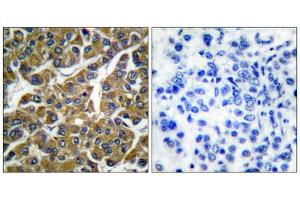 Immunohistochemical analysis of paraffin-embedded human breast carcinoma tissue, using MMP3 antibody (ABIN5976463). (MMP3 antibody  (C-Term))