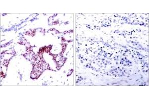 Immunohistochemistry analysis of paraffin-embedded human breast carcinoma, using NF-kappaB p65 (Phospho-Ser276) Antibody. (NF-kB p65 antibody  (pSer276))