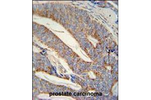 DACT1 antibody immunohistochemistry analysis in formalin fixed and paraffin embedded human prostate carcinoma followed by peroxidase conjugation of the secondary antibody and DAB staining. (DACT1 antibody  (N-Term))