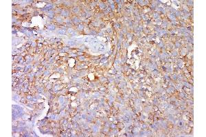 Paraformaldehyde-fixed, paraffin embedded human lung carcinoma tissue, Antigen retrieval by boiling in sodium citrate buffer(pH6) for 15min, Block endogenous peroxidase by 3% hydrogen peroxide for 30 minutes, Blocking buffer (normal goat serum) at 37°C for 20min, Antibody incubation with Rabbit Anti-Zyxin (Ser142+Ser143) Polyclonal Antibody, Unconjugated  at 1:500 overnight at 4°C, followed by a conjugated secondary and DAB staining (ZYX antibody  (pSer142, pSer143))