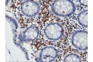 Immunohistochemical staining of paraffin-embedded Carcinoma of Human lung tissue using anti-ARHGAP25 mouse monoclonal antibody. (ARHGAP25 antibody)