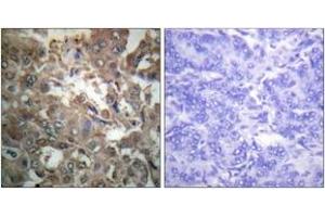 Immunohistochemistry analysis of paraffin-embedded human breast carcinoma tissue, using XPA Antibody. (PA (AA 211-260) antibody)
