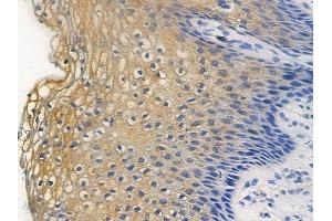 ABIN6255524 and ABIN6267296 at 1/100 staining human cervical carcinoma by IHC-P. (HSP27 antibody  (pSer82))