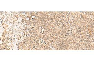 Immunohistochemistry of paraffin-embedded Human ovarian cancer tissue using FBXL4 Polyclonal Antibody at dilution of 1:25(x200) (FBXL4 antibody)