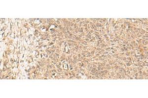 Immunohistochemistry of paraffin-embedded Human ovarian cancer tissue using FBXL4 Polyclonal Antibody at dilution of 1:25(x200)