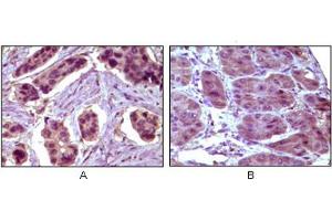 Immunohistochemical staining (Formalin-fixed paraffin-embedded sections) of (A) human breast carcinoma and (B) liver carcinoma, showing cytoplasmic localization with DAB staining. (BCL10 antibody)