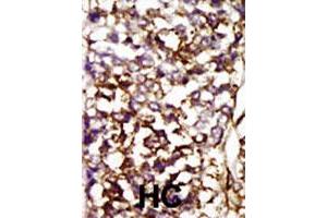 Formalin-fixed and paraffin-embedded human hepatocellular carcinoma tissue reacted with CDK4 polyclonal antibody  , which was peroxidase-conjugated to the secondary antibody, followed by AEC staining.