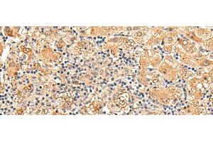 Immunohistochemistry of paraffin-embedded Human liver cancer tissue using GPD1L Polyclonal Antibody at dilution of 1:60(x200) (GPD1L antibody)