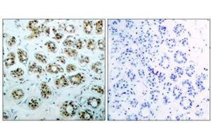 Immunohistochemical analysis of paraffin-embedded human breast carcinoma tissue, using NFκB-p65 (phospho-Ser311) antibody (E011260). (NF-kB p65 antibody  (pSer311))