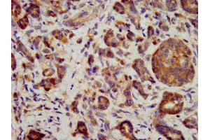 IHC image of ABIN7156494 diluted at 1:400 and staining in paraffin-embedded human pancreatic cancer performed on a Leica BondTM system. (ITGB6 antibody  (AA 451-586))