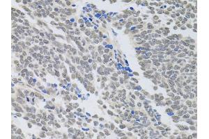 Immunohistochemistry of paraffin-embedded human lung cancer using PAX3 antibody (ABIN6290725) at dilution of 1:100 (40x lens).
