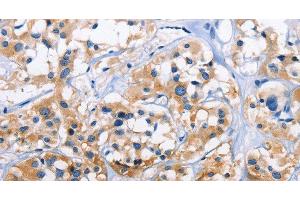 Immunohistochemistry of paraffin-embedded Human thyroid cancer tissue using CAPZA3 Polyclonal Antibody at dilution 1:70 (CAPZA3 antibody)