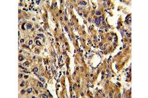 IHC analysis of FFPE human hepatocarcinoma stained with ABCG1 antibody (ABCG1 antibody  (AA 359-387))