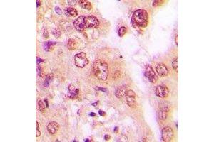 Immunohistochemical analysis of PSMA6 staining in human lung cancer formalin fixed paraffin embedded tissue section. (PSMA6 antibody)
