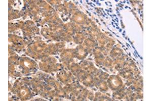 The image on the left is immunohistochemistry of paraffin-embedded Human thyroid cancer tissue using ABIN7128689(BTG3 Antibody) at dilution 1/15, on the right is treated with fusion protein. (BTG3 antibody)
