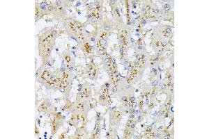 Immunohistochemistry of paraffin-embedded human colon carcinoma using GOLPH2 Rabbit pAb  at dilution of 1:100 (40x lens). (GOLM1 antibody)