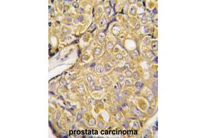 Formalin-fixed and paraffin-embedded human prostate carcinoma tissue reacted with TRPM8 polyclonal antibody  , which was peroxidase-conjugated to the secondary antibody, followed by DAB staining.
