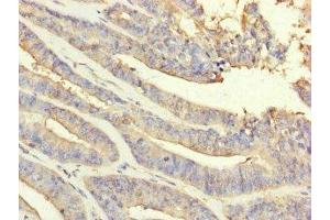 Immunohistochemistry of paraffin-embedded human endometrial cancer using ABIN7162936 at dilution of 1:100 (Peroxiredoxin 2 antibody  (AA 2-65))