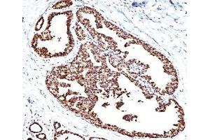 Formalin/paraffin human breast carcinoma stained with HSP60 antibody (HSPD1 antibody)