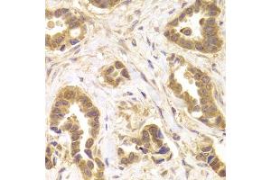 Immunohistochemistry of paraffin-embedded human mammary cancer using ROCK2 antibody (ABIN5973333) at dilution of 1/100 (40x lens).