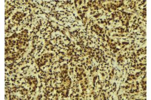 ABIN6274223 at 1/100 staining Human breast cancer tissue by IHC-P. (GTF2E2 antibody  (Internal Region))