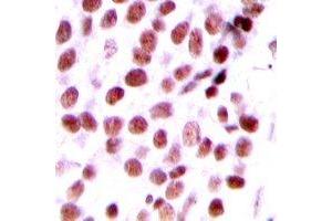 Immunohistochemical analysis of DIDO1 staining in human breast cancer formalin fixed paraffin embedded tissue section.