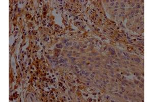 IHC image of ABIN7165087 diluted at 1:200 and staining in paraffin-embedded human cervical cancer performed on a Leica BondTM system. (AGO1 antibody  (AA 251-400))