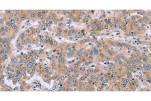 Immunohistochemistry of paraffin-embedded Human liver cancer using MAPRE3 Polyclonal Antibody at dilution of 1:30 (ECE1 antibody)