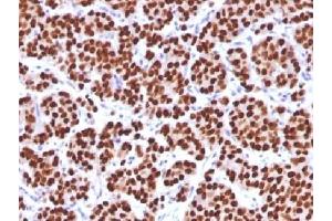 IHC testing of FFPE human prostate carcinoma with FOXA1 antibody (clone FOXA1/1512). (FOXA1 antibody  (AA 372-472))