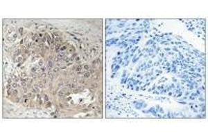 Immunohistochemistry analysis of paraffin-embedded human lung carcinoma tissue using SPTBN5 antibody.