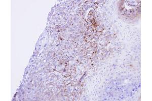 IHC-P Image Immunohistochemical analysis of paraffin-embedded Cal27 xenograft , using CACNA1S, antibody at 1:100 dilution. (CACNA1S antibody  (Center))