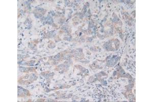 Detection of VNN1 in Human Breast Cancer Tissue using Polyclonal Antibody to Vanin 1 (VNN1) (VNN1 antibody  (AA 36-223))