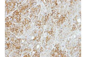 IHC-P Image Immunohistochemical analysis of paraffin-embedded SW480 xenograft, using PFKL, antibody at 1:500 dilution. (PFKL antibody  (Center))