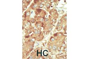 Formalin-fixed and paraffin-embedded human hepatocellular carcinoma tissue reacted with NLK polyclonal antibody  , which was peroxidase-conjugated to the secondary antibody, followed by DAB staining. (Nemo-Like Kinase antibody  (C-Term))