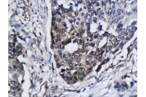 Formalin-fixed and paraffin embedded human breast cancer labeled with Anti SIRT3 Polyclonal Antibody, Unconjugated  followed by conjugation to the secondary antibody and DAB staining