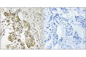 Immunohistochemistry analysis of paraffin-embedded human breast carcinoma, using TAGAP Antibody.