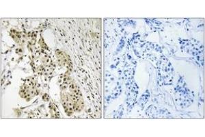 Immunohistochemistry analysis of paraffin-embedded human breast carcinoma, using TAGAP Antibody. (TAGAP antibody  (AA 191-240))