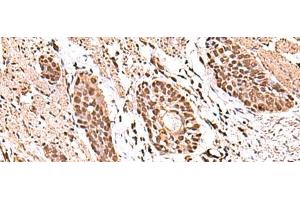 Immunohistochemistry of paraffin-embedded Human esophagus cancer tissue using ACTL6B Polyclonal Antibody at dilution of 1:100(x200) (Actin-Like 6B antibody)