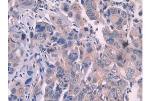Used in DAB staining on fromalin fixed paraffin- embedded stomach cancer tissue (OAS1 antibody  (AA 74-165))